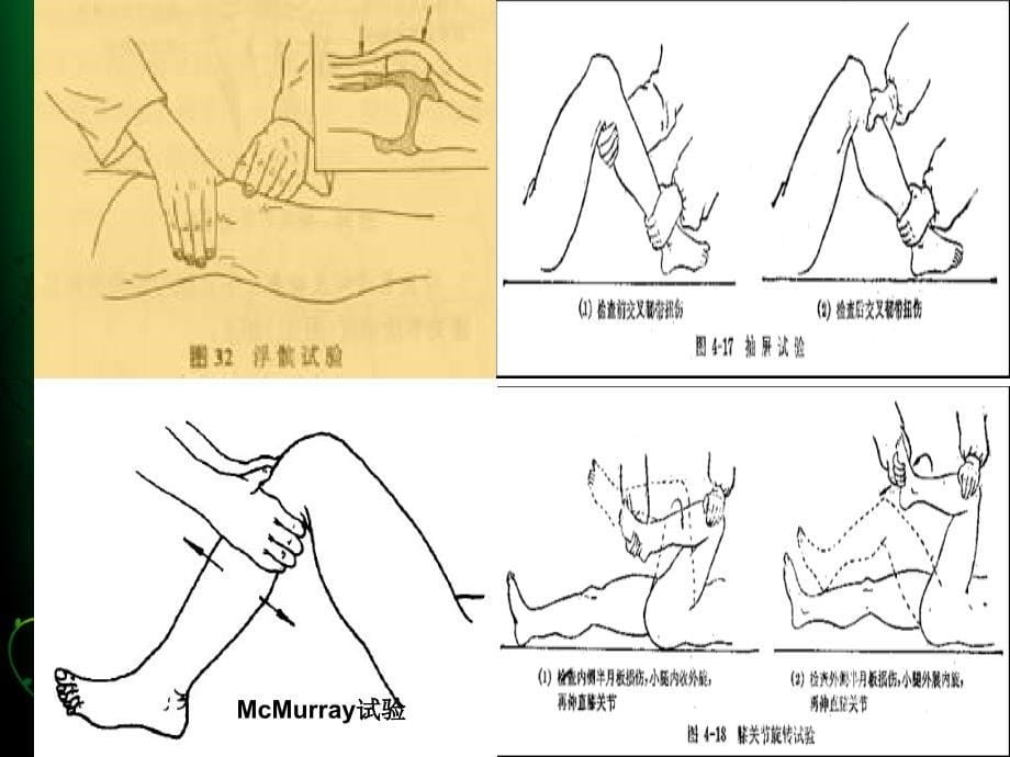 医学--膝关节骨性关节炎护理查房课件_第5页