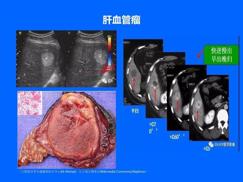 肝脏良性肿瘤的诊治PPT_第5页