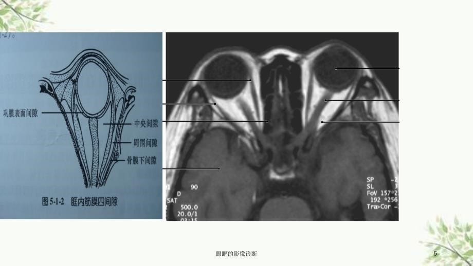 眼眶的影像诊断课件_第5页