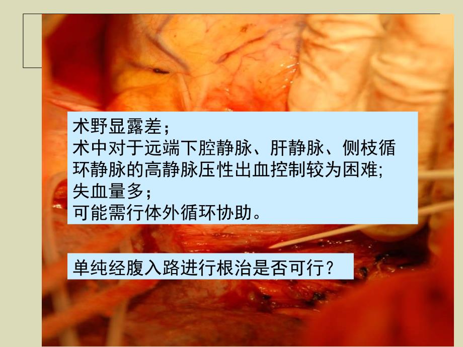 腔静脉疾病的手术治疗_第4页