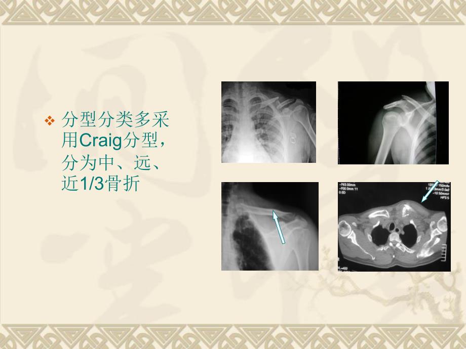 锁骨骨折闭合穿针术_第3页