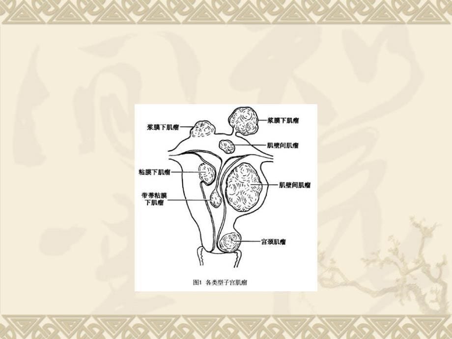 日常生活和子宫肌瘤文档资料_第5页