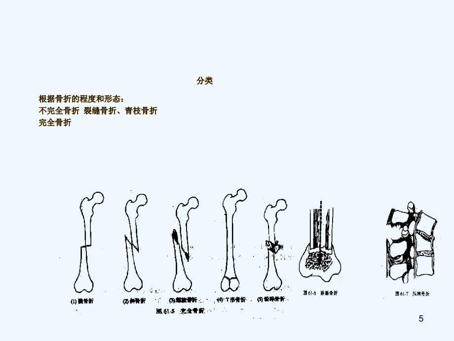 常见四肢骨折概况课件_第5页