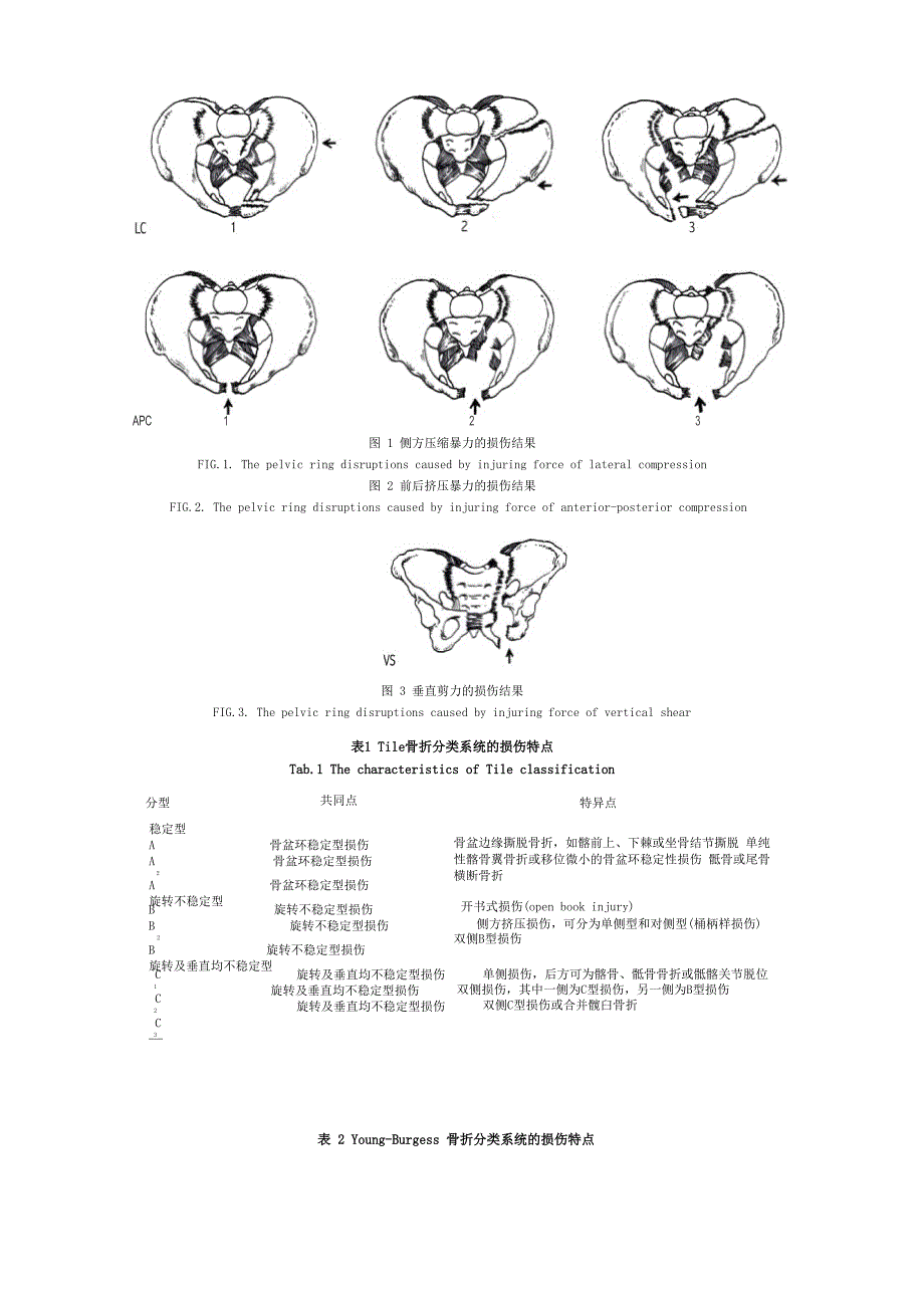 骨盆骨折的分类及内固定治疗_第2页