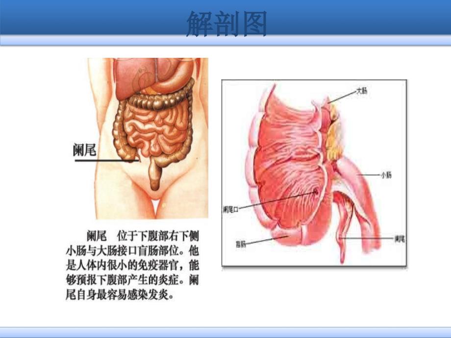 《阑尾炎护理》PPT课件_第3页