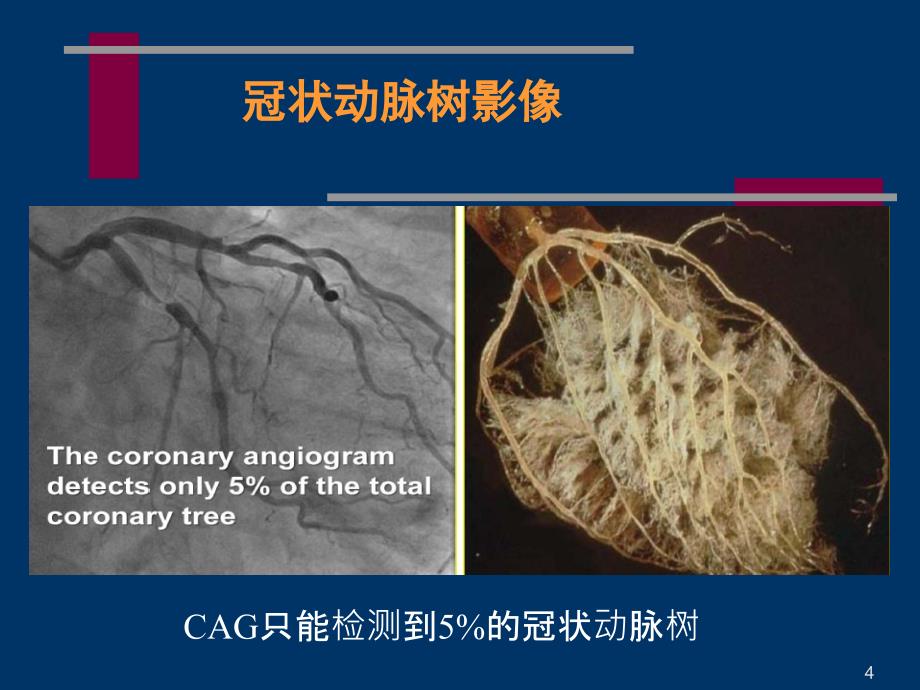 冠状动脉微血管病变及对策_第4页