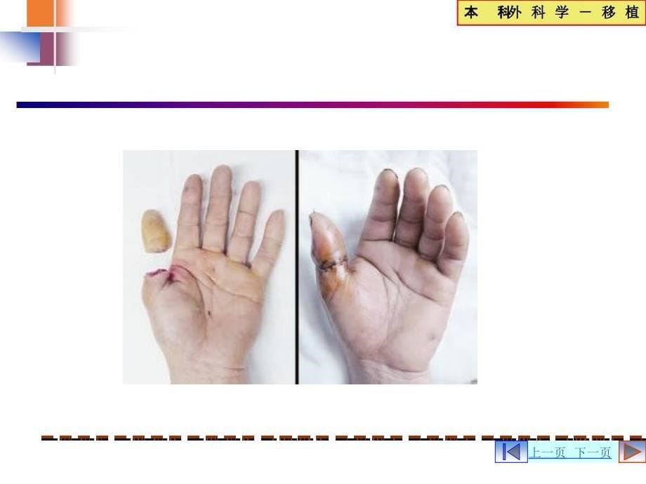 外科学课件：器官移植 (transplantation)_第5页