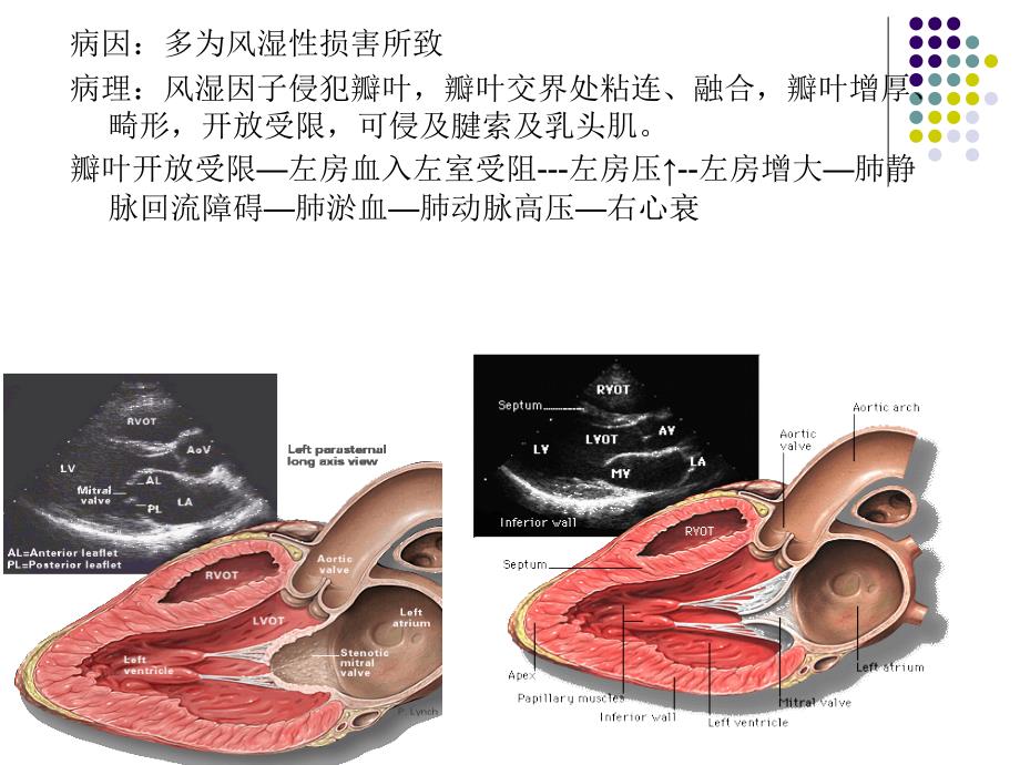 后天获得性心脏病瓣膜病课件_第3页