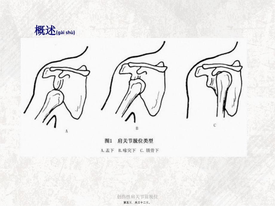 创伤性肩关节前脱位课件_第5页