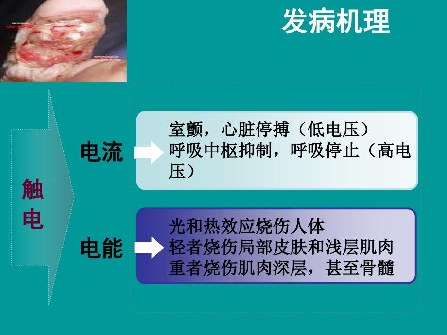 电击伤的急救与护理.ppt_第4页