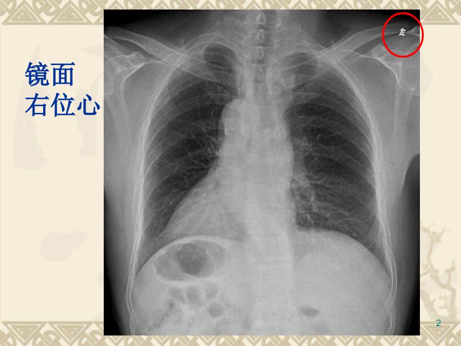 循环系统先天性病变3先心ppt课件文档资料_第2页