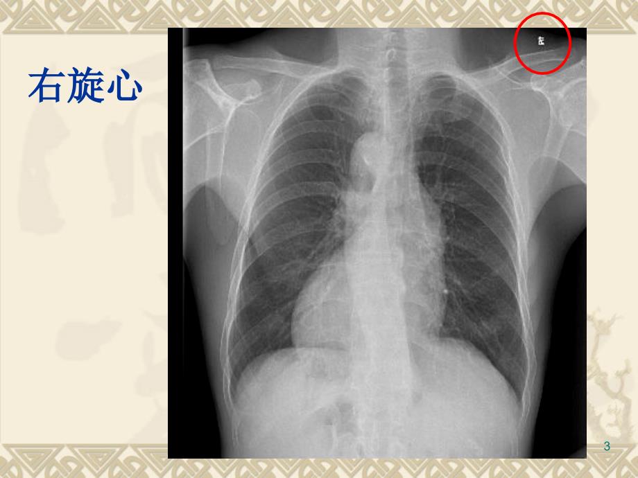 循环系统先天性病变3先心ppt课件文档资料_第3页