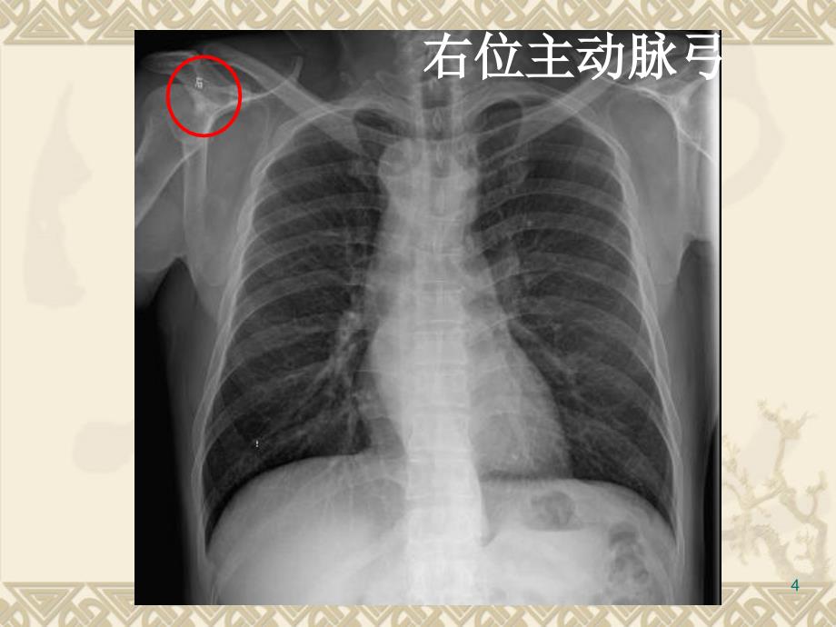 循环系统先天性病变3先心ppt课件文档资料_第4页