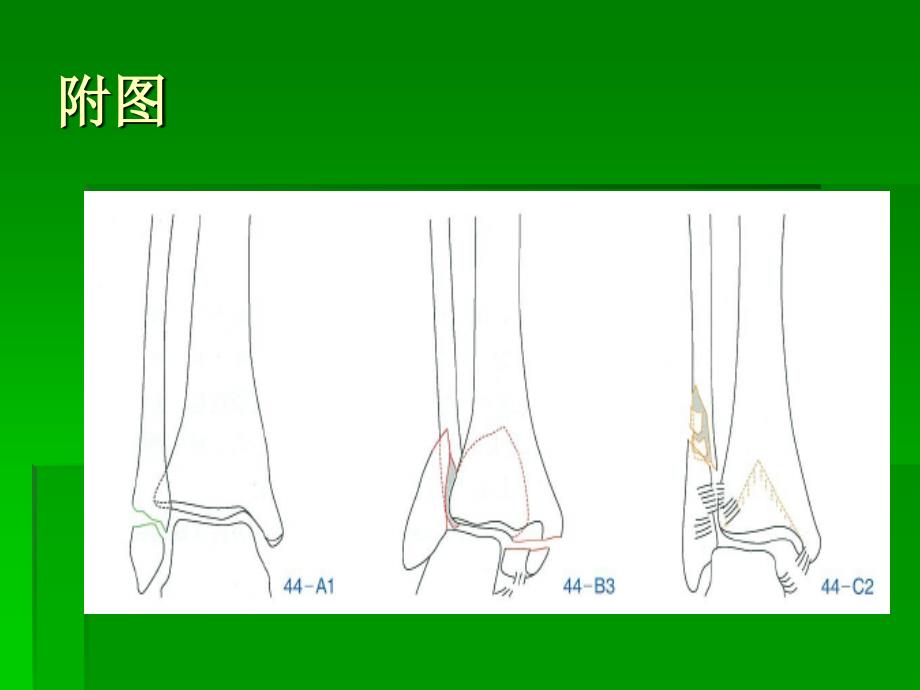 踝关节骨折AO分型课件_第3页