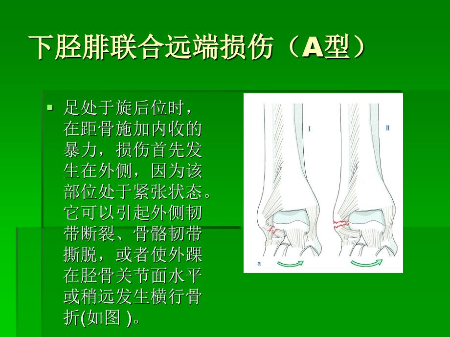 踝关节骨折AO分型课件_第4页