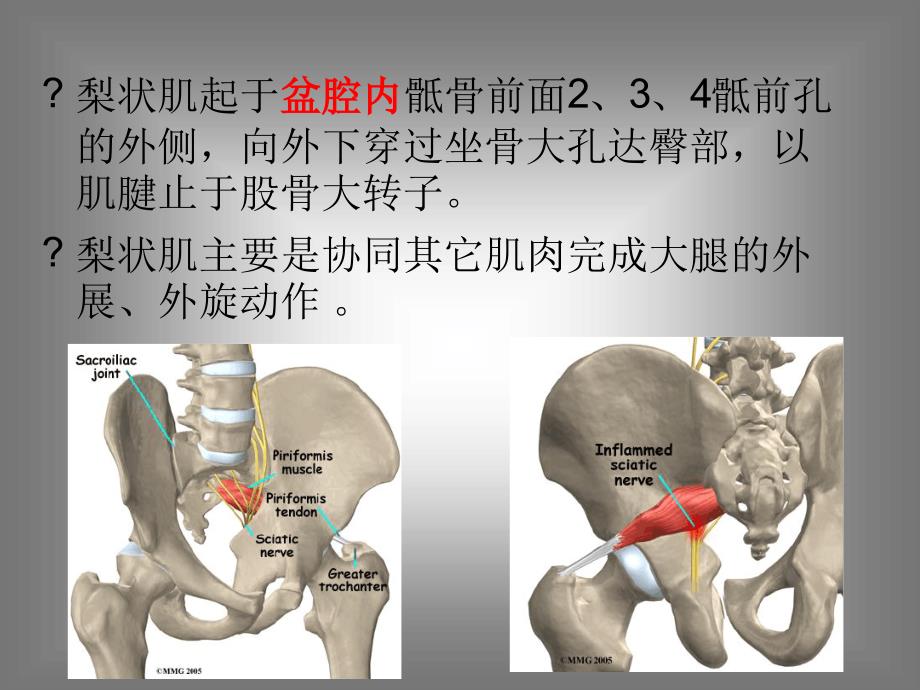 梨状肌综合征课件.ppt_第4页