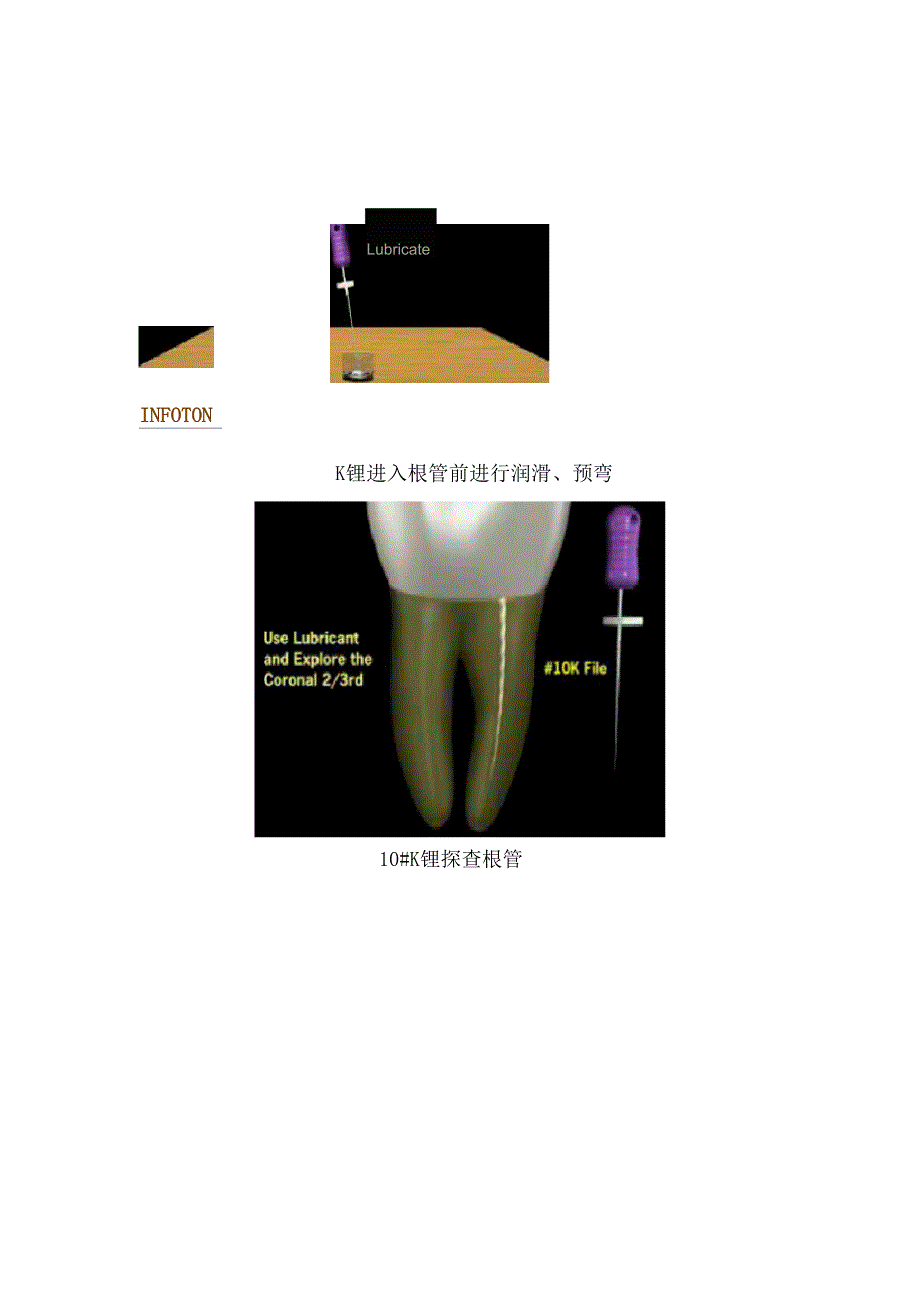 根管预备操作流程_第2页