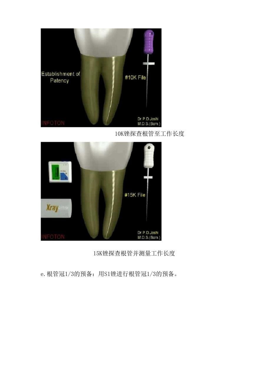 根管预备操作流程_第5页