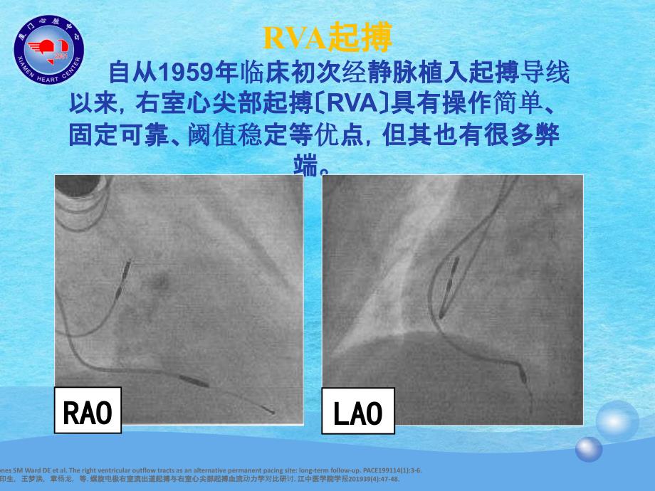 右室间隔部起搏植入技术ppt课件_第2页