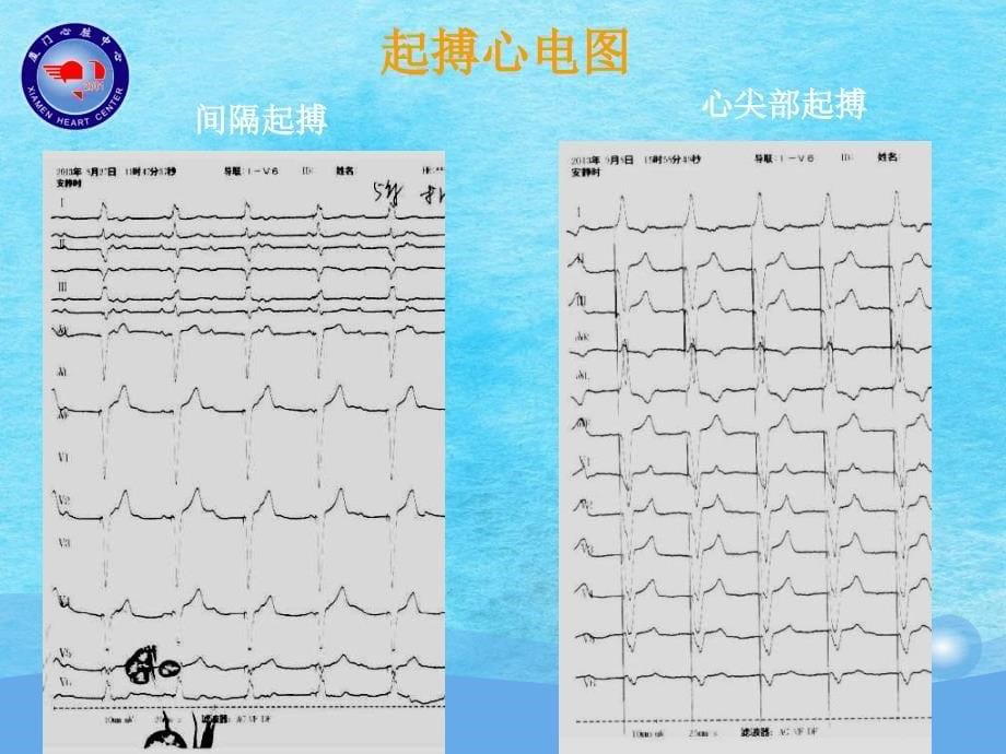 右室间隔部起搏植入技术ppt课件_第5页