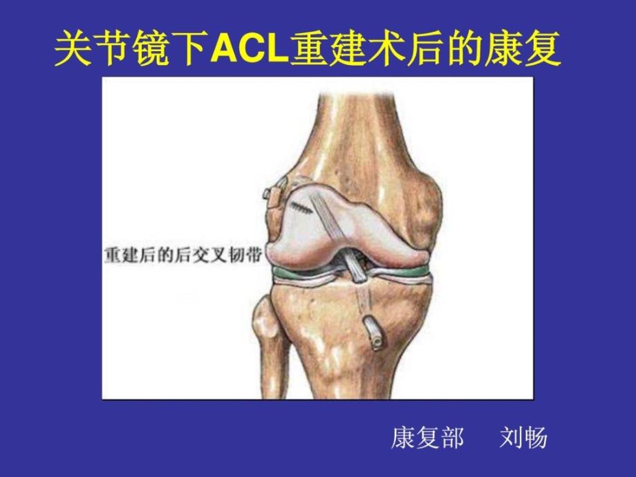 关节镜下acl重建术后康复(刘畅).ppt_第1页