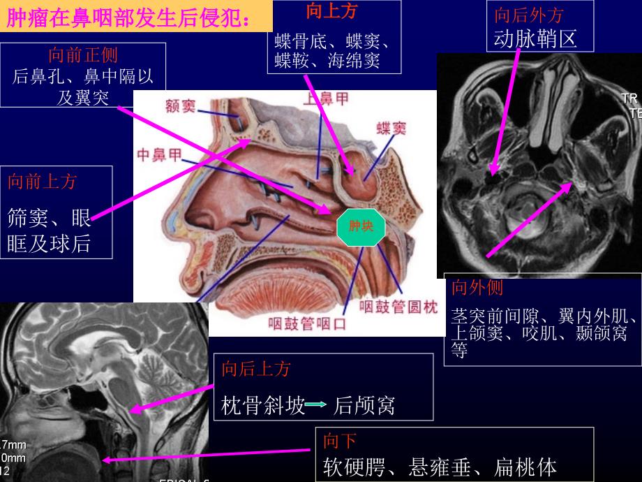 鼻咽癌影像诊断学习_第2页