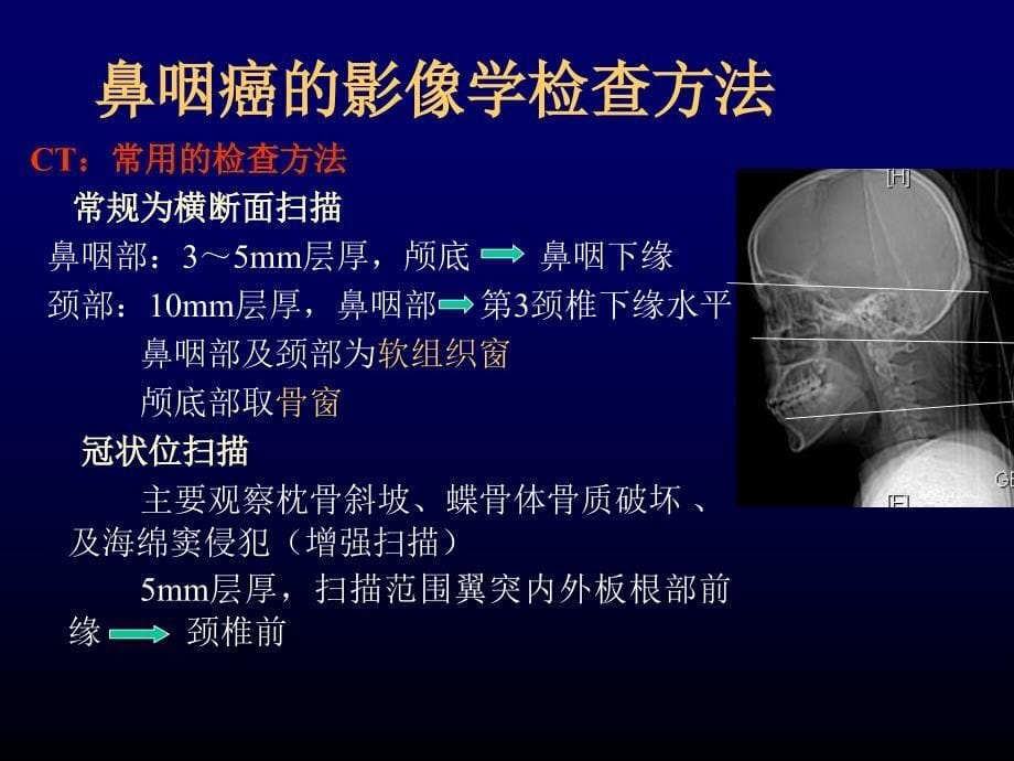 鼻咽癌影像诊断学习_第5页