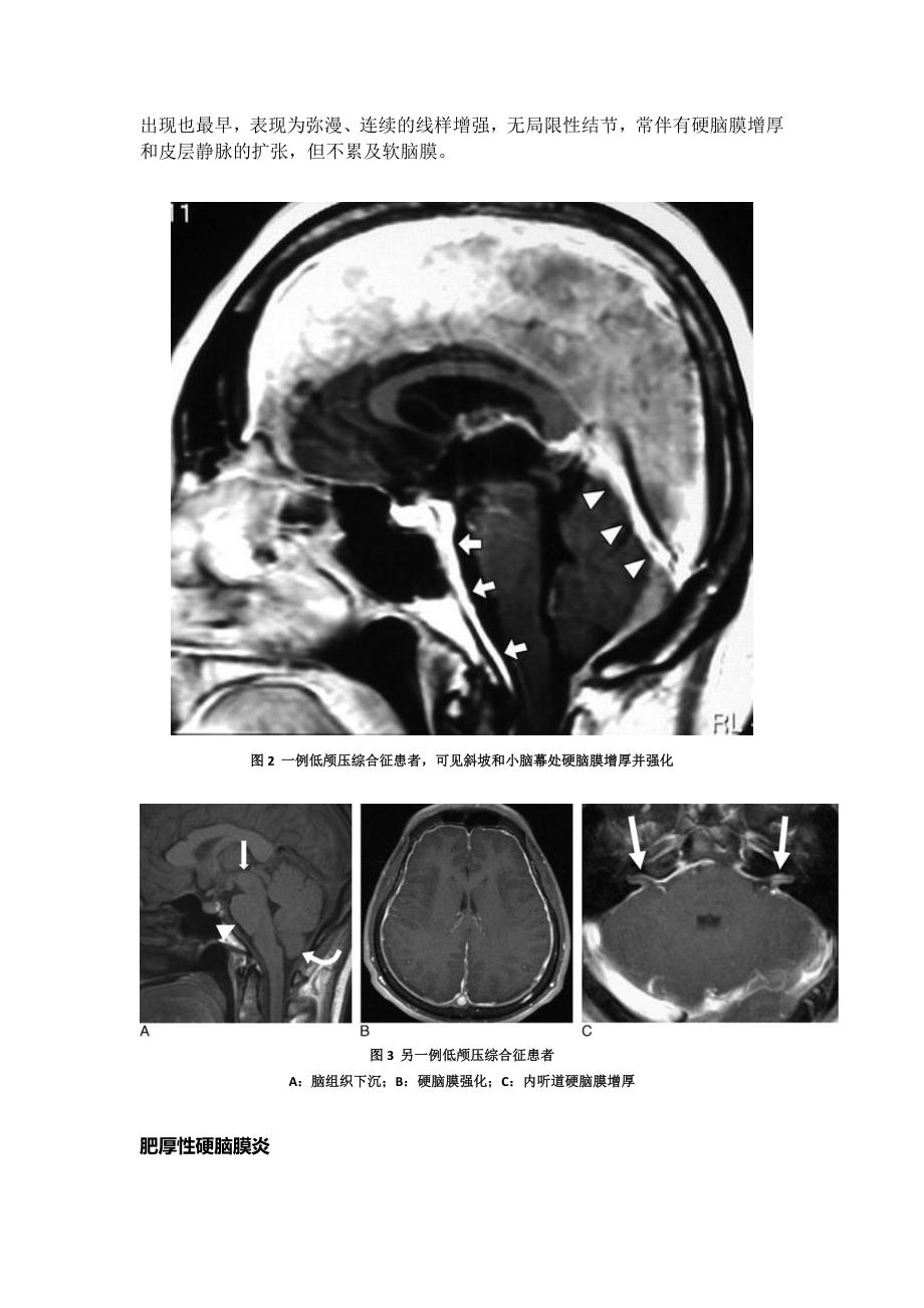 脑膜强化的常见类型与鉴别诊断_第3页