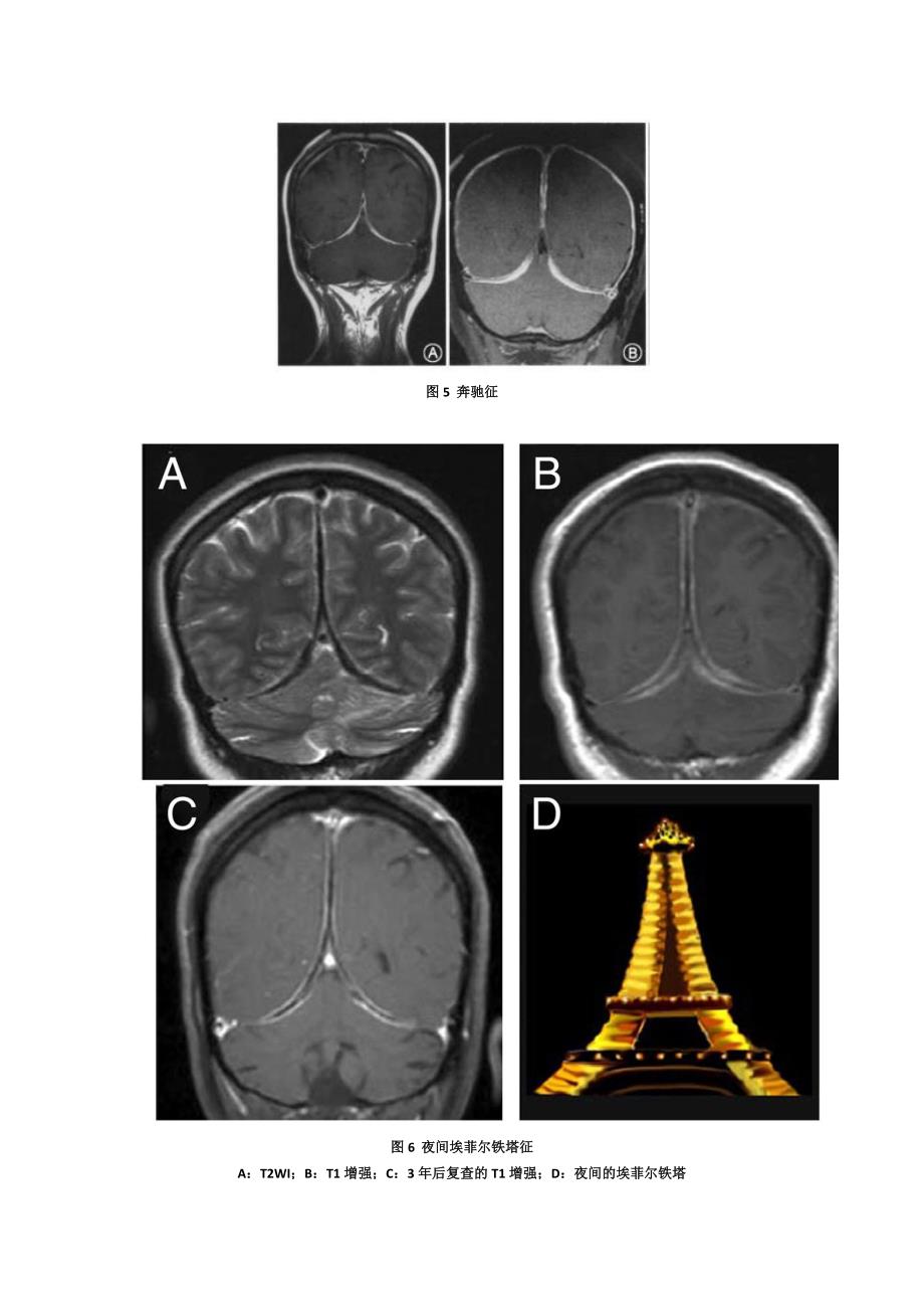 脑膜强化的常见类型与鉴别诊断_第5页
