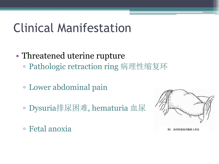 子宫破裂八年制名师编辑PPT课件_第4页