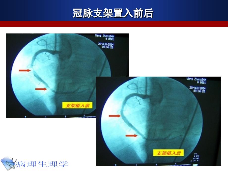 医学超级全之病生临710缺血再灌注损伤课件_第2页