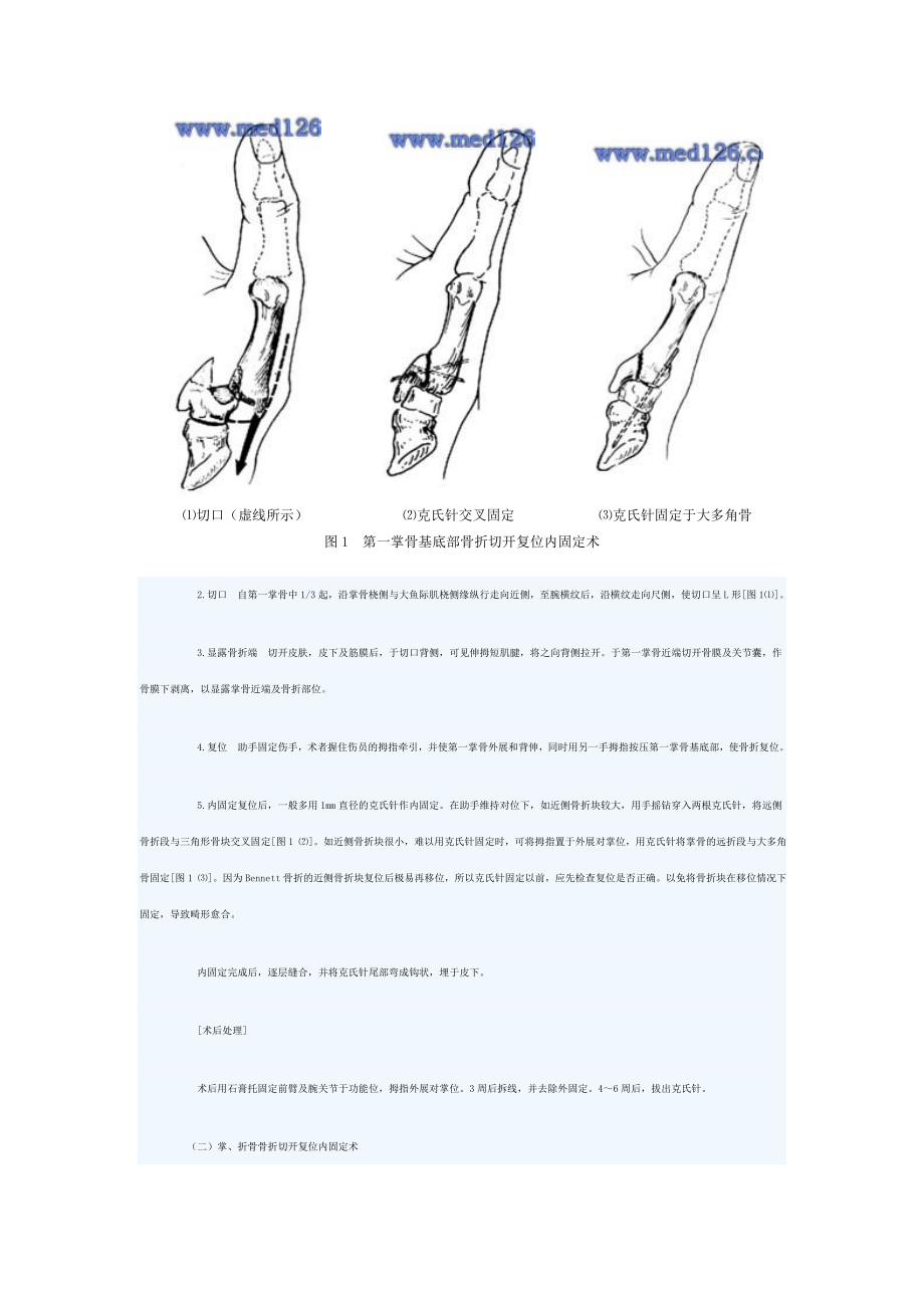 掌骨、指骨骨折治疗手术切开复位内固定术_第2页