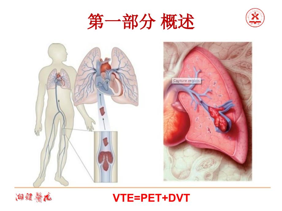 肺栓塞指南解读_第3页