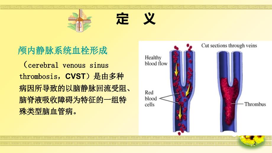 （精选课件）一例颅内静脉窦血栓形成病人的护理_第2页