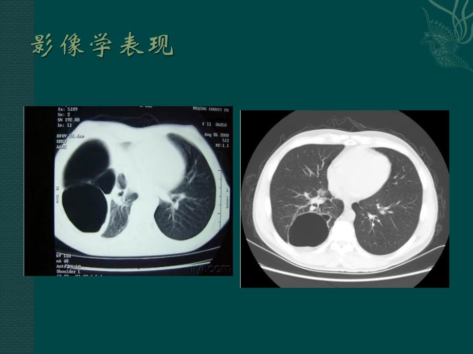 肺部囊性病变PPT课件_第4页