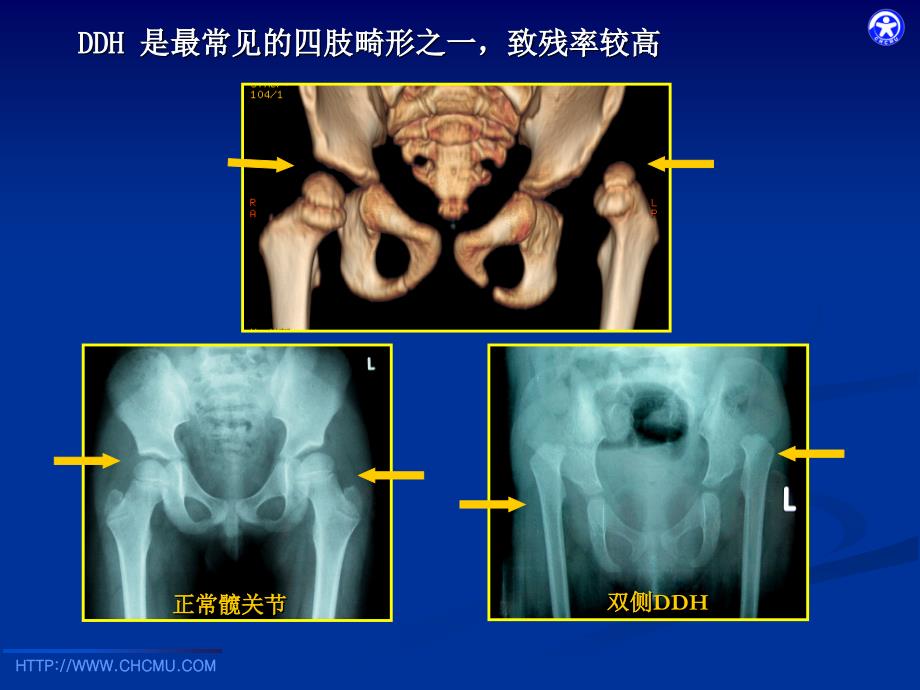 儿科学教学课件：发育性髋关节发育不良_第4页