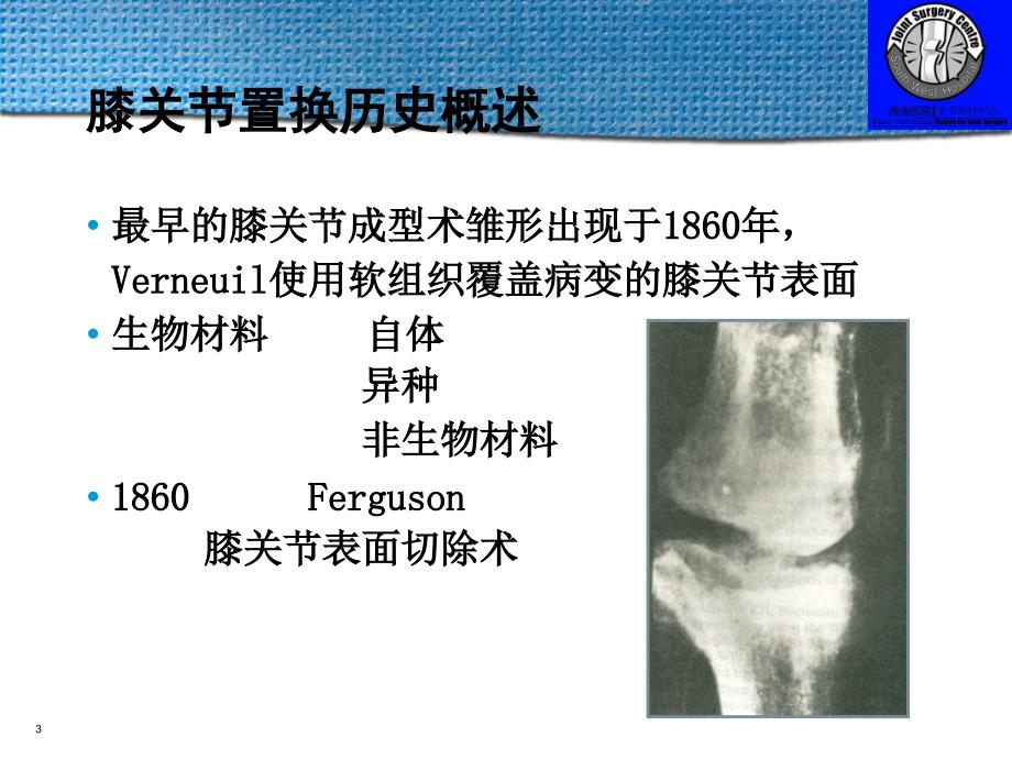 膝关节置换的假体类型_第3页