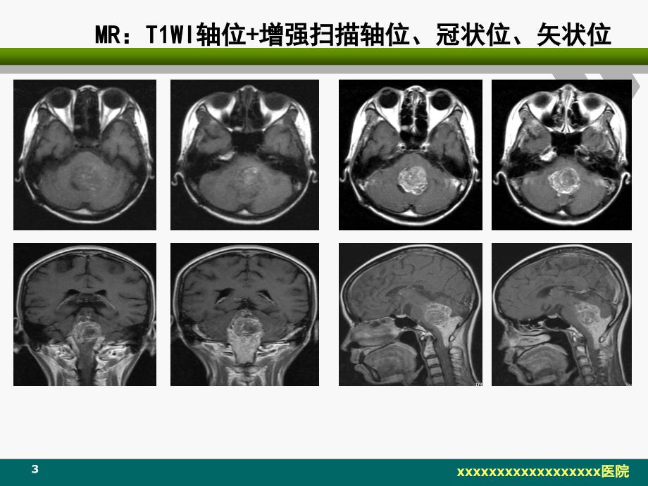 脑室内室管膜瘤的影像诊断及鉴别课件_第3页