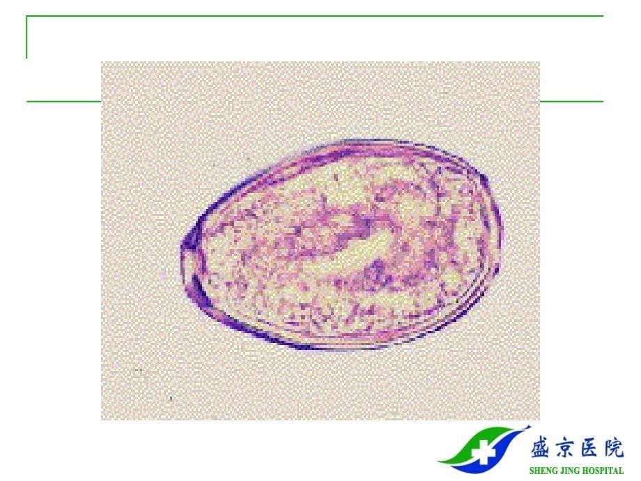 并殖吸虫病肺吸虫病paragonimiasisP_第5页