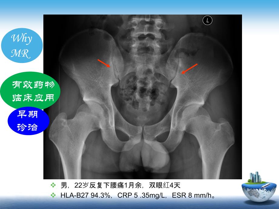 医学影像-SpA骶髂关节炎的影像学诊断与鉴别诊断课件_第4页