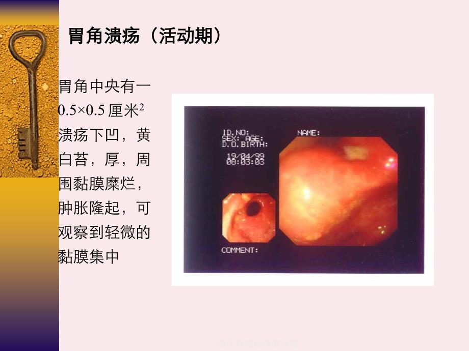 消化性溃疡详解含图_第2页