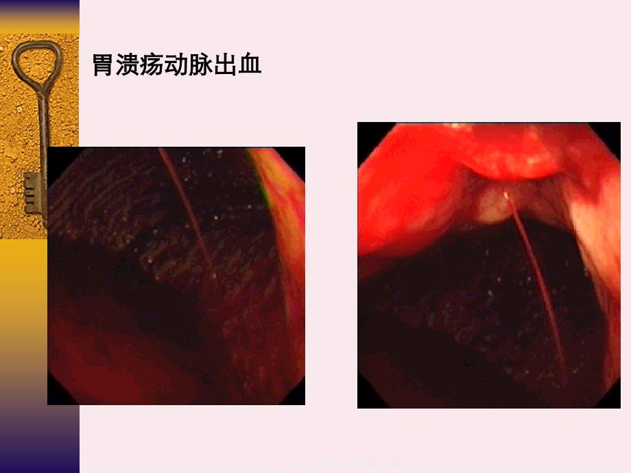 消化性溃疡详解含图_第3页