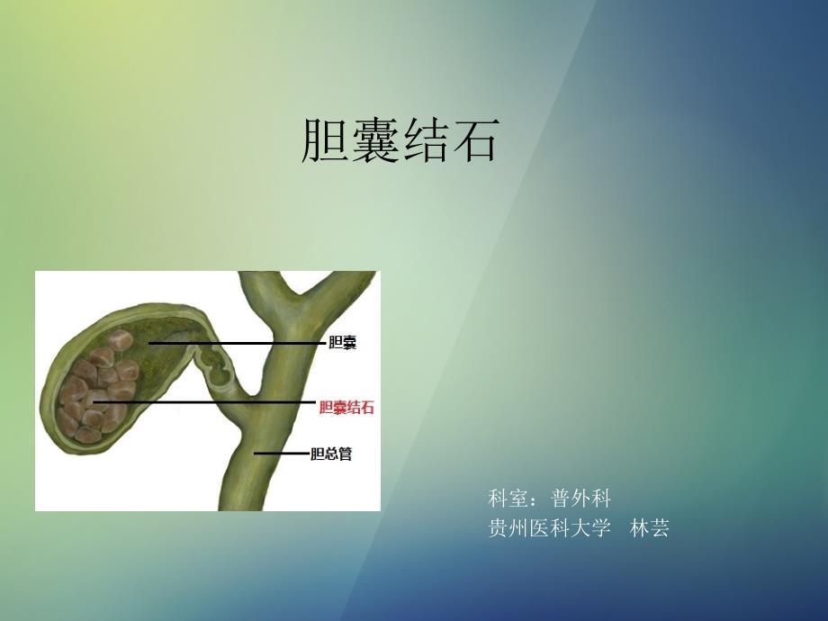 胆囊结石