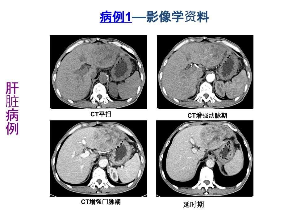 常见肝脏肿瘤分析PPT课件_第5页