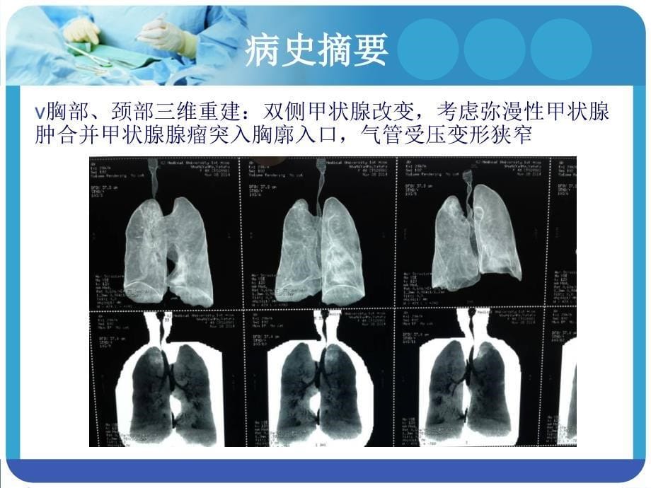 巨大甲状腺肿麻醉PPT课件_第5页