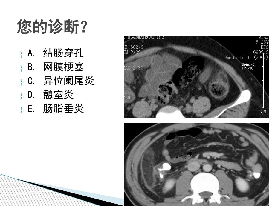 腹腔炎性脂肪性肿块的鉴别诊断_第3页