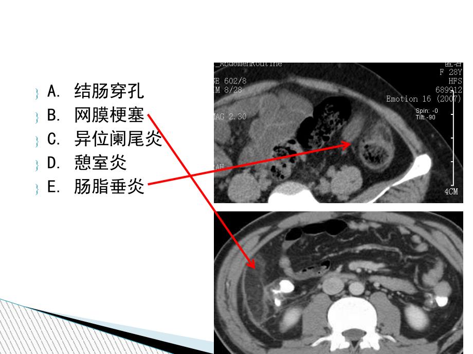 腹腔炎性脂肪性肿块的鉴别诊断_第4页