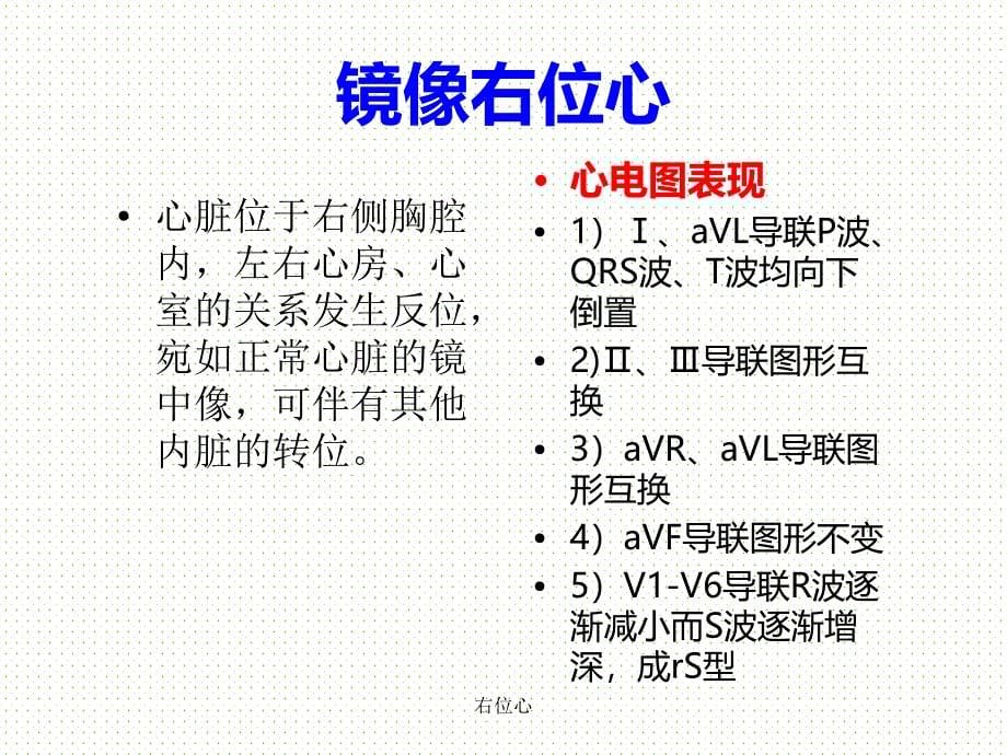 右位心心电图表现_第5页