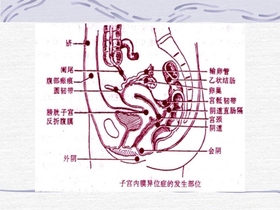 王斌教授：子宫内膜异位征是什么,有什么症状_第4页