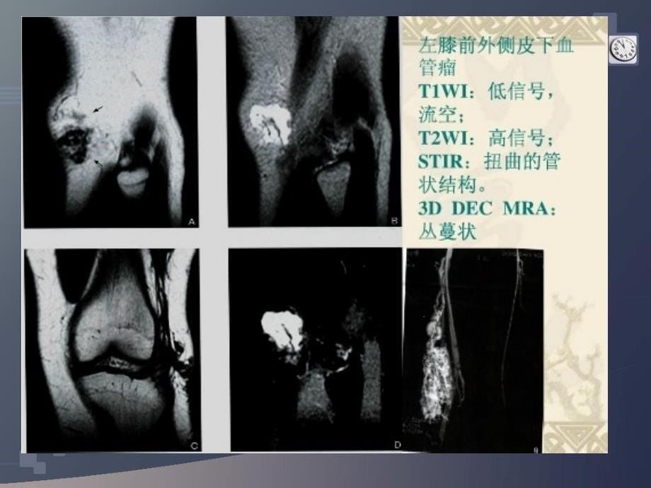 软组织占位MR表现ppt参考课件_第5页